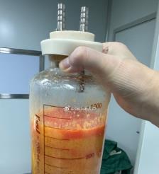 宁阳水动力吸脂手术要做多久？